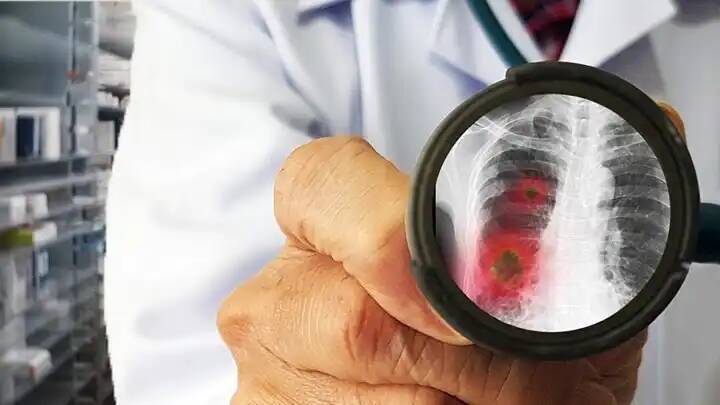 Эпидемия пневмонии, вызванной микоплазмой. Жаропонижающие не действуют. Неужели это новый виток коронавируса?