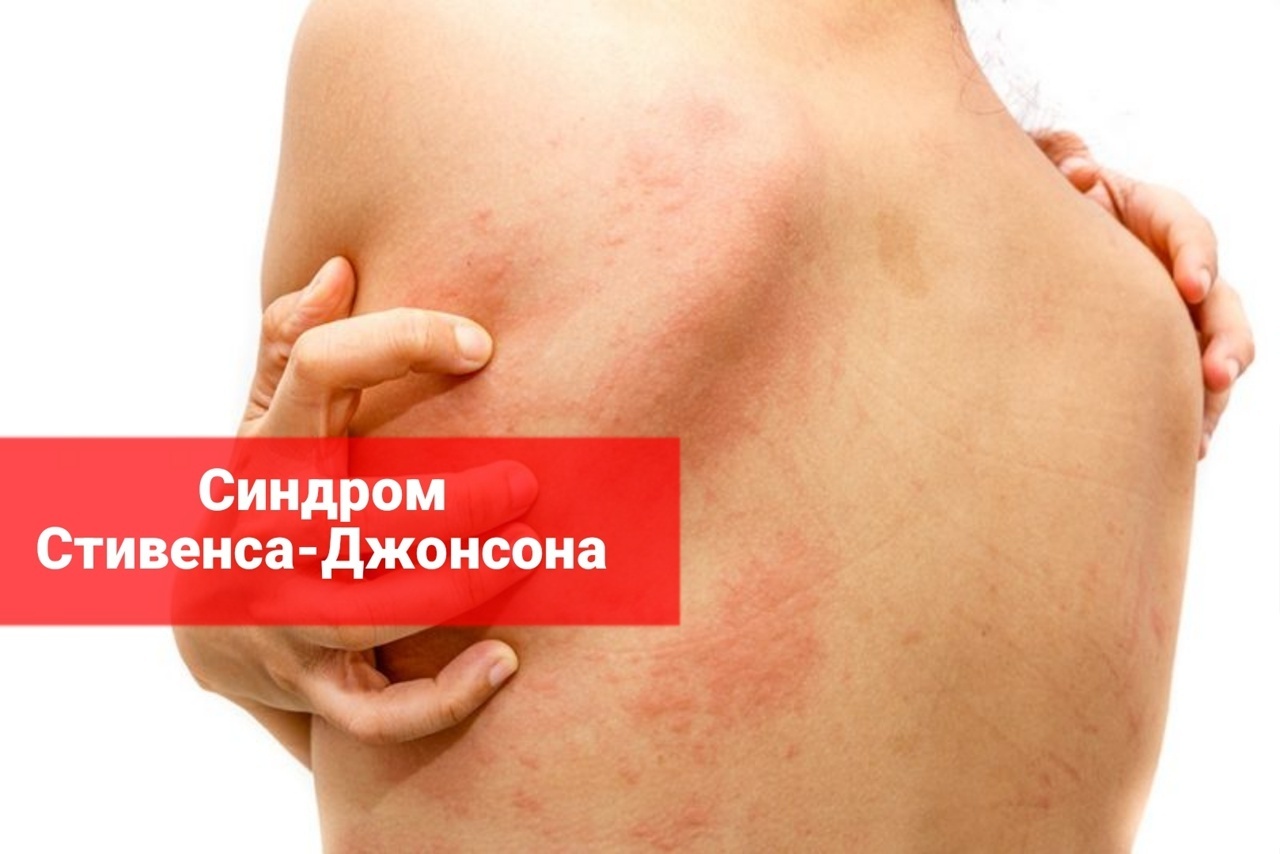 Синдром Стивенса-Джонсона и служба в армии