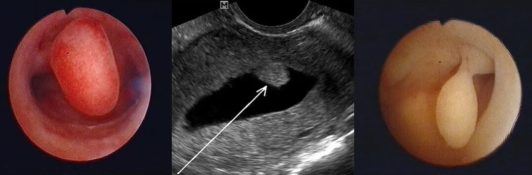 Заключение гистологического анализа после удаления полипа в гинекологическом отделении Одинцовской больницы