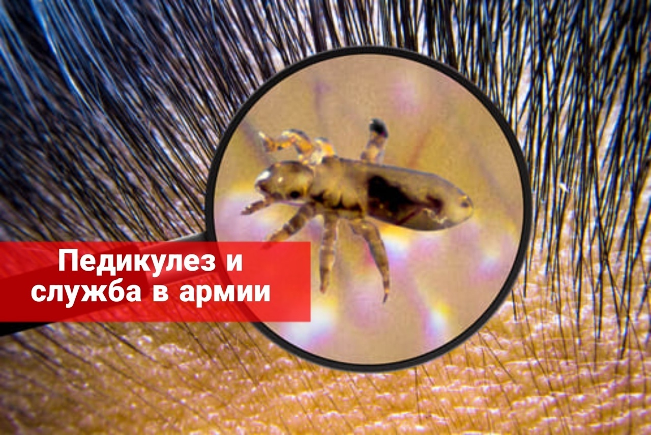 Педикулез и служба в армии