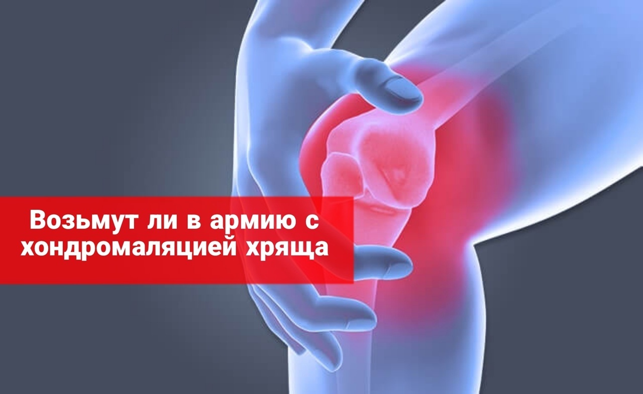 Возьмут ли в армию с хондромаляцией хряща