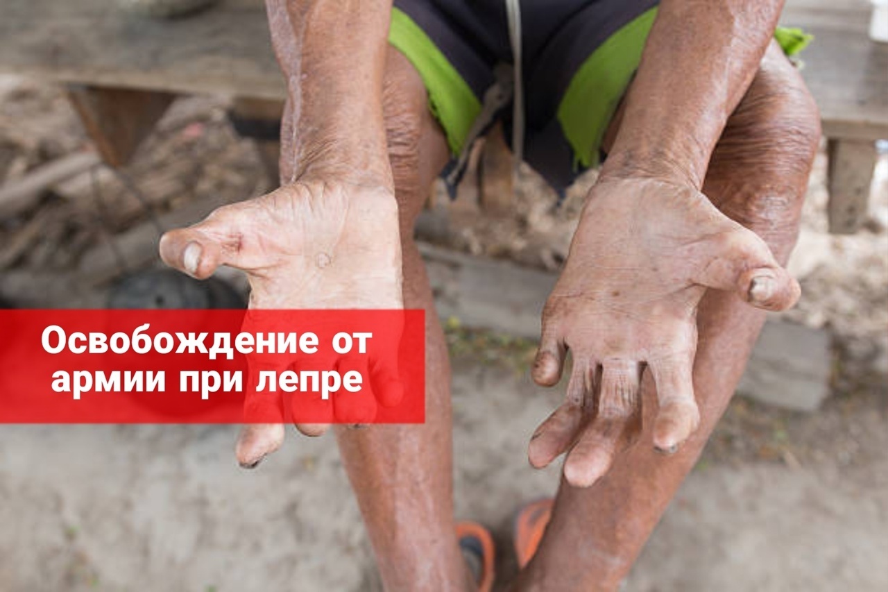 Освобождение от армии при лепре, какие категории годности подложены