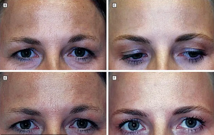 ✅ Кто выглядит лучше? - Одна близняшка ставила ботокс 20 лет, а вторая - нет (фото, опрос) 🧐