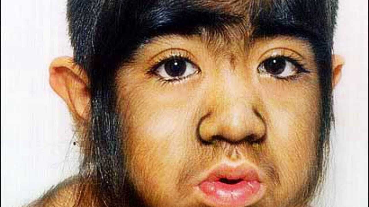 Синдром оборотня - страшное заболевание, меняющее облик человека