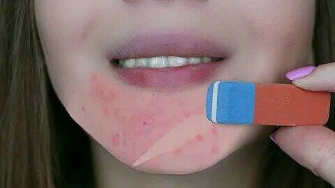 Как избавиться от прыщей в раннем возрасте.