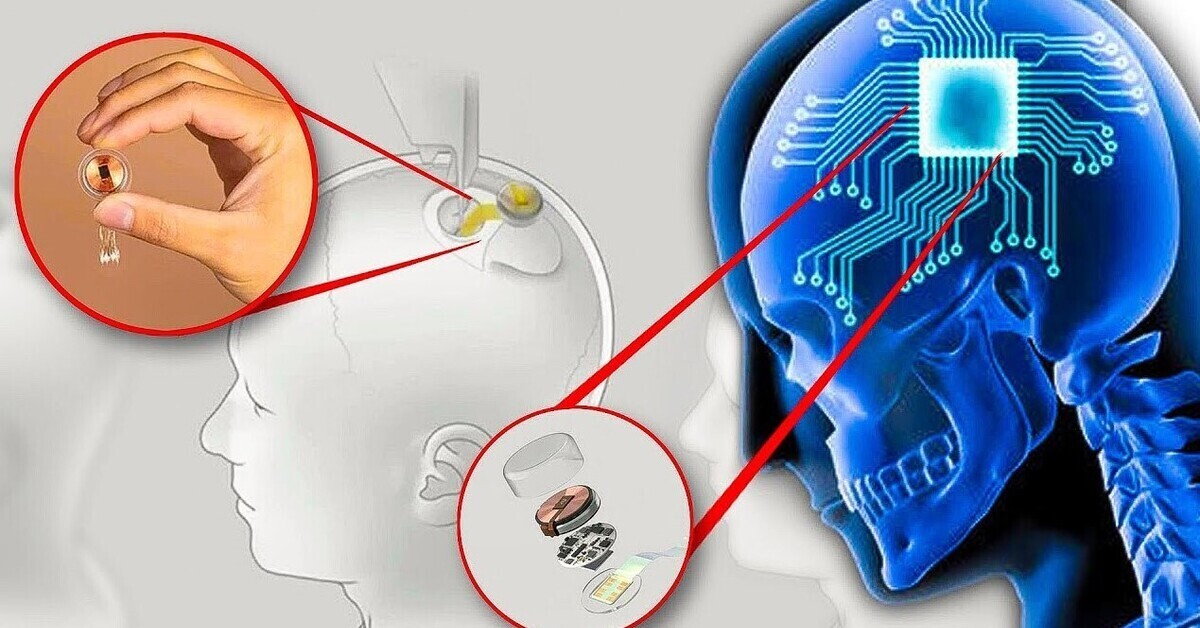 Вживили нейрочип в мозг человека.