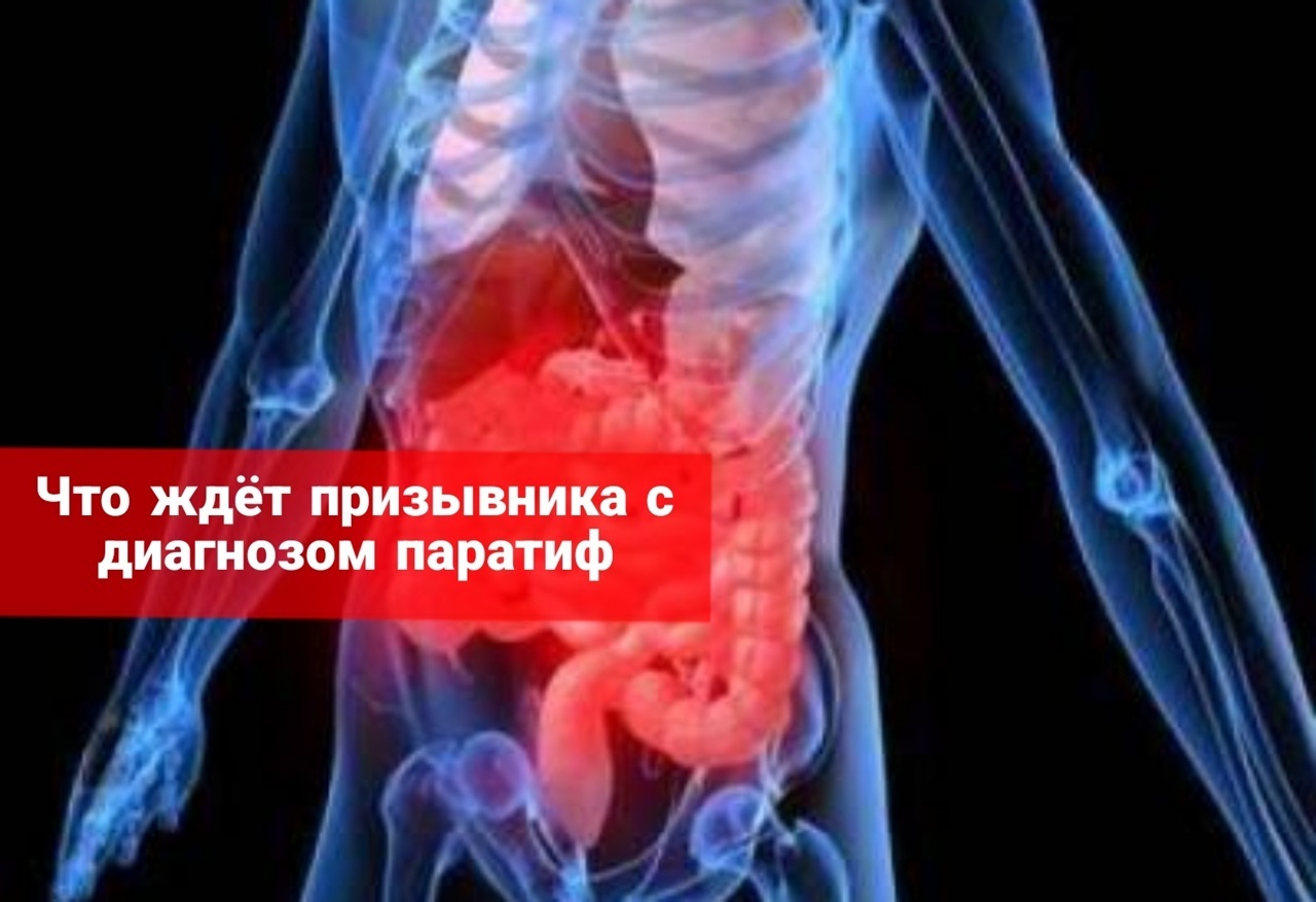 Берут ли в армию с паратифом