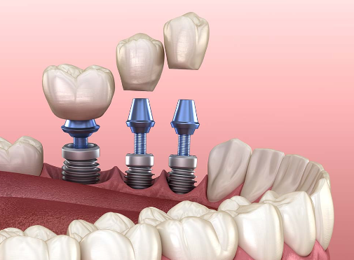 Зубной имплантат: сколько времени занимает заживление?