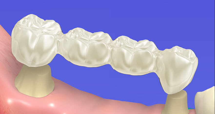 Зубной имплантат: сколько времени занимает заживление?