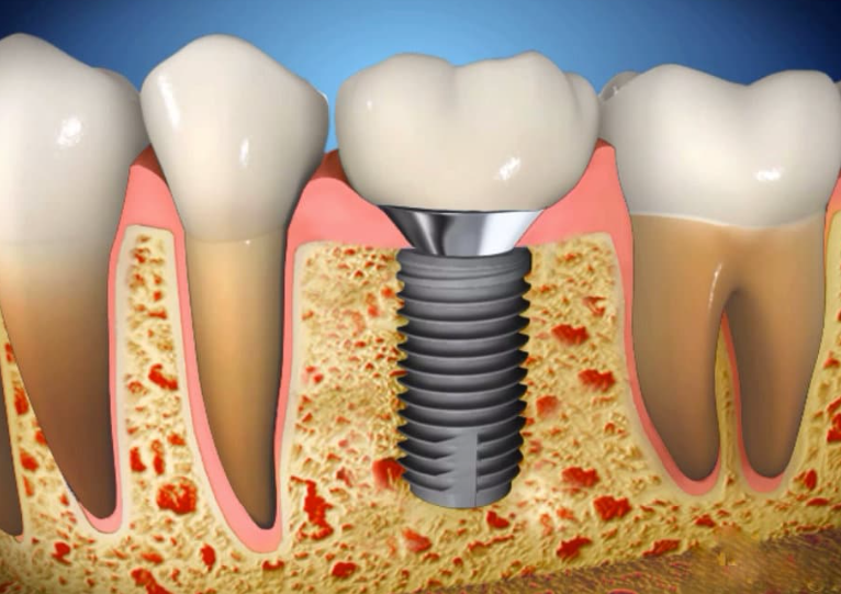 Зубной имплантат: сколько времени занимает заживление?