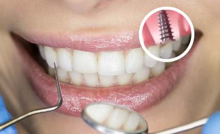 Зубной имплантат: сколько времени занимает заживление?