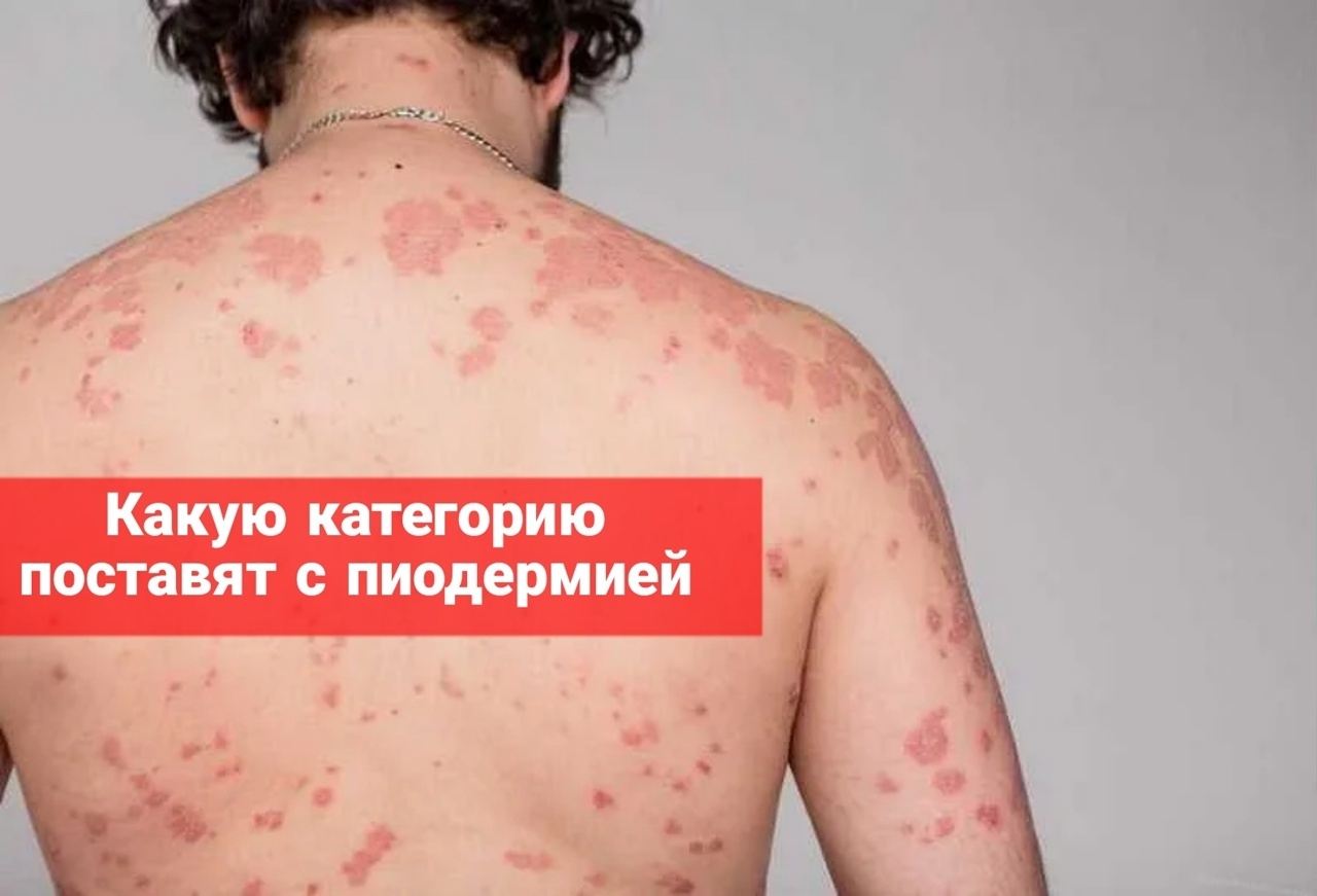 Какую категорию годности поставят с пиодермией