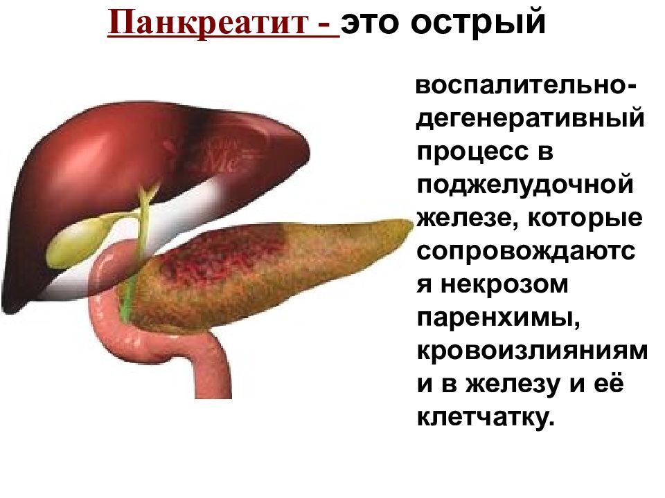 Как вылечить печень и поджелудочную. Острый панкреатит поджелудочной железы. Болезнь хронический панкреатит поджелудочной железы. Желчекаменная болезнь и панкреатит связь. Острый панкреатит, некроз поджелудочной.