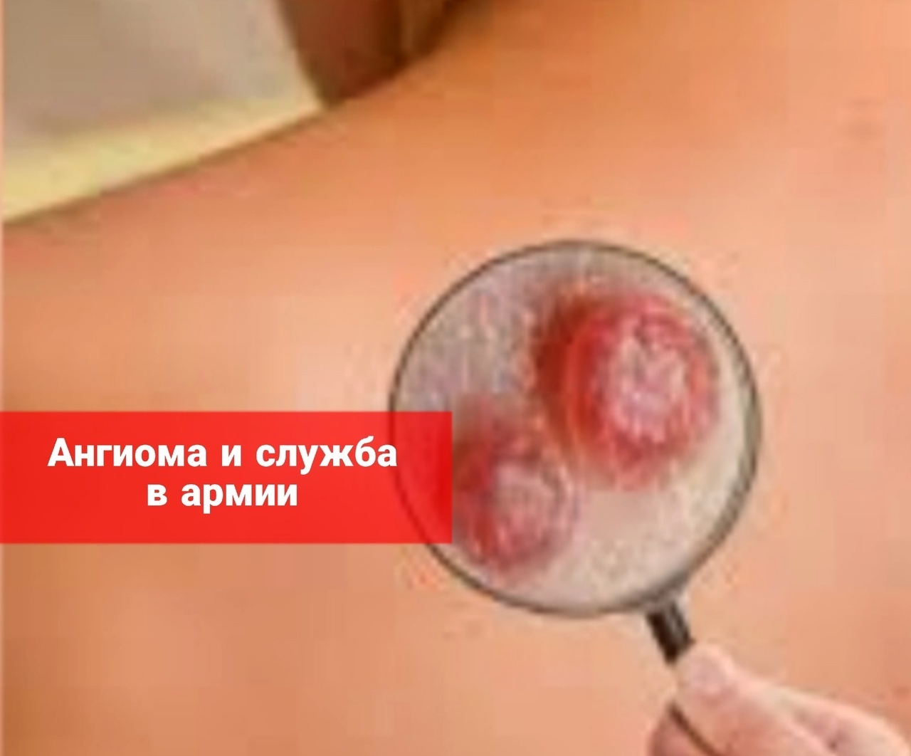 Ангиома и служба в армии