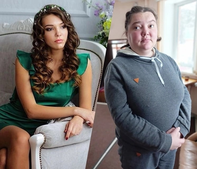 По вине жениха потеряла красоту и зрение, а он её бросил. Как сейчас живёт бывшая модель, попавшая в страшную аварию