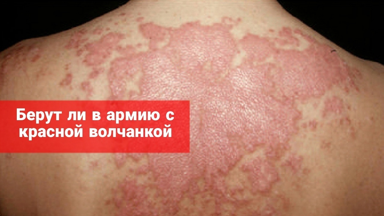 Берут ли в армию с красной волчанкой