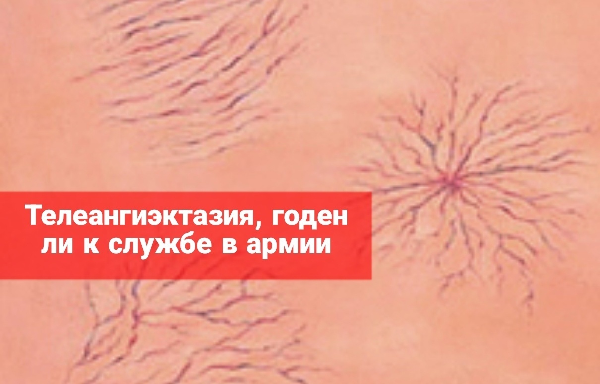 Телеангиэктазия, годен ли к службе