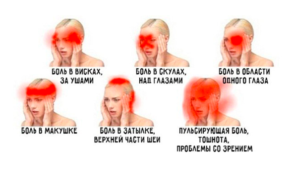 Сильную боль в голове. И как избавиться от сильной боли.
