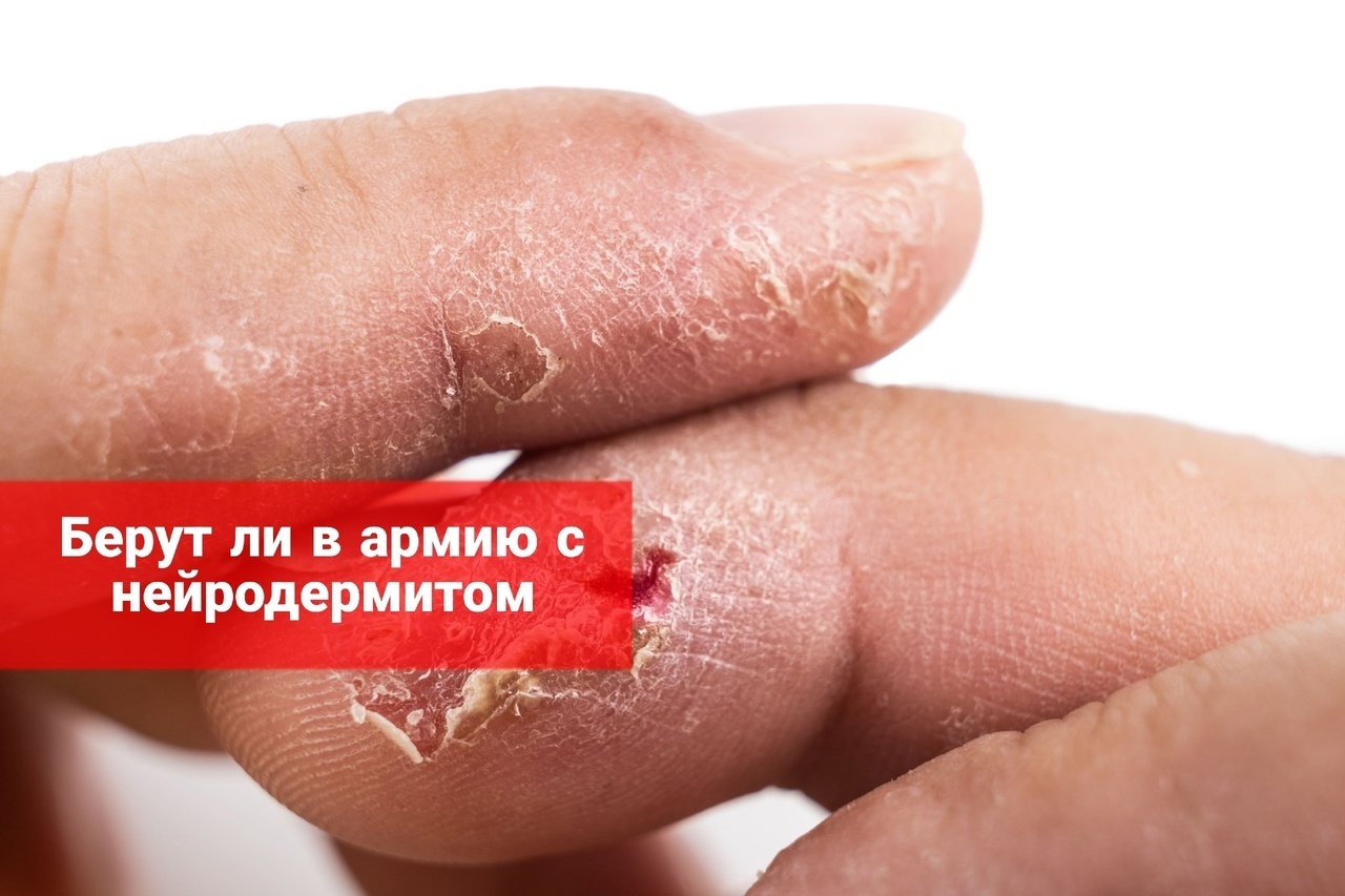 Берут ли в армию с нейродермитом