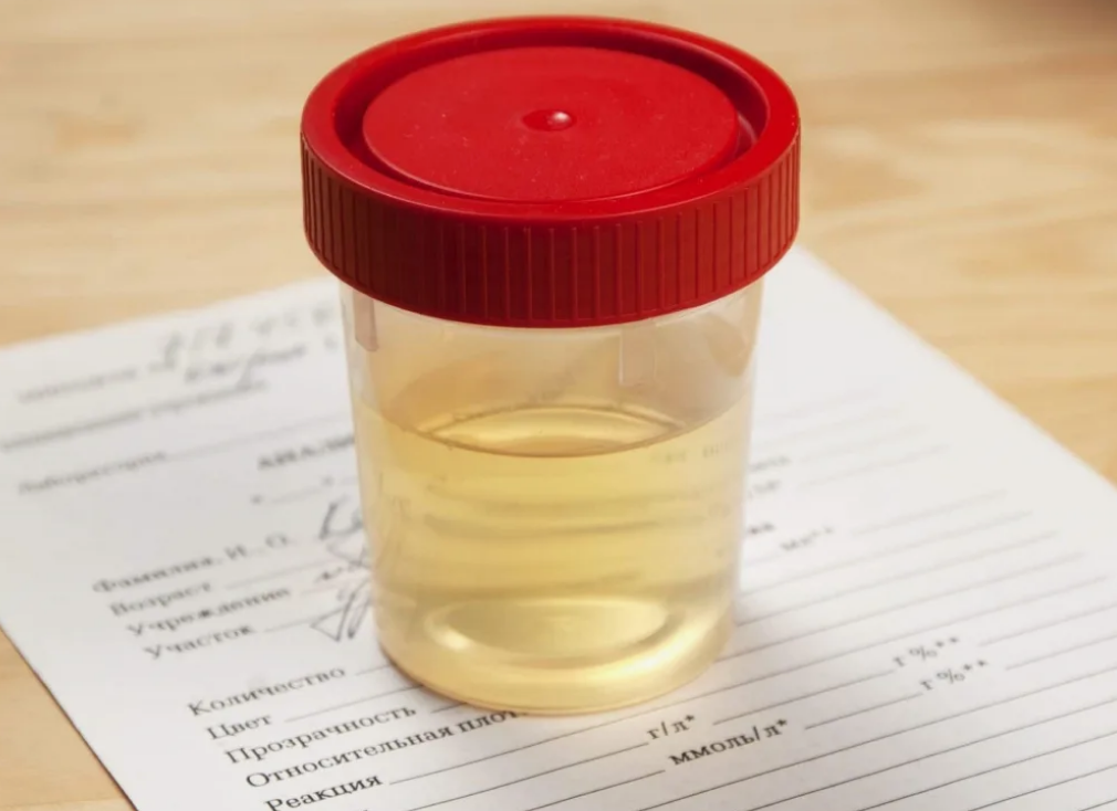 Зачем врач назначает анализ мочи по Нечипоренко?