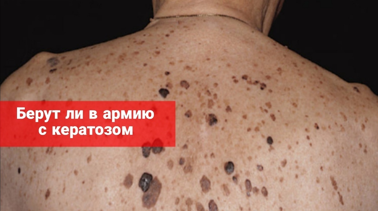 Берут ли в армию с кератозом