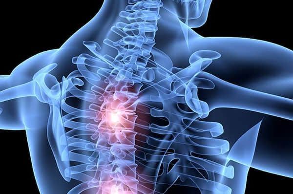Возможные причины защемления нерва в позвоночнике