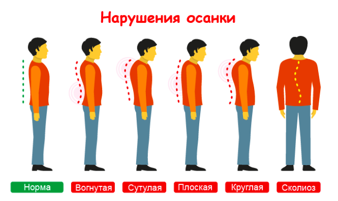 Как сохранить здоровье спины работая за компьютером🧘‍♂️ Профилактика сколиоза и других заболеваний спины при сидячей работе