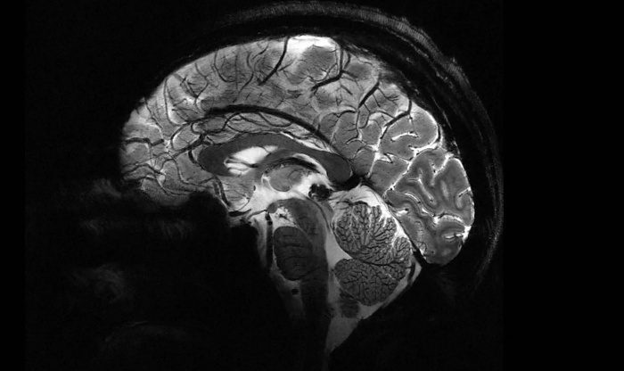 Во Франции создан самый мощный в мире МРТ-аппарат Iseult