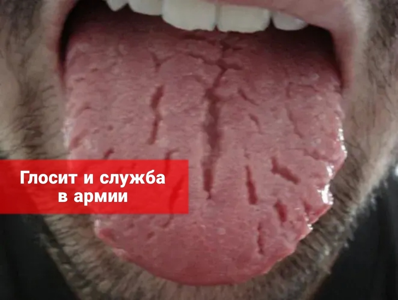 Глоссит и служба в армии