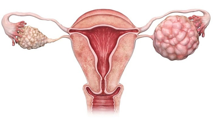Оперативное лечение синдрома поликистозных яичников у пациенток с бесплодием.