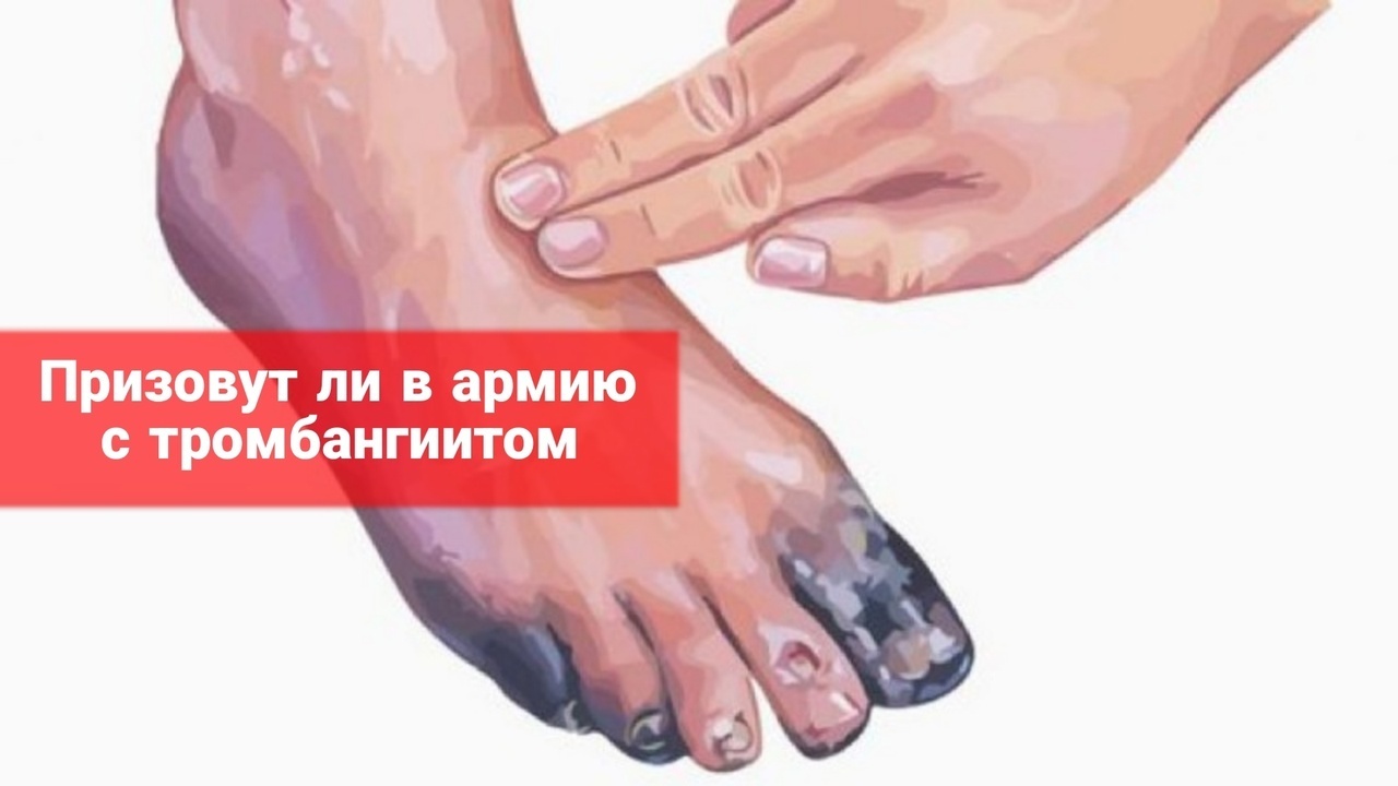Призовут ли в армию с тромбангиитом