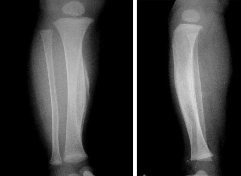 Гиперостоз кости рентген. Гиперостоз бедренной кости рентген. Рентген большеберцовой кости. Периостит голени рентген.