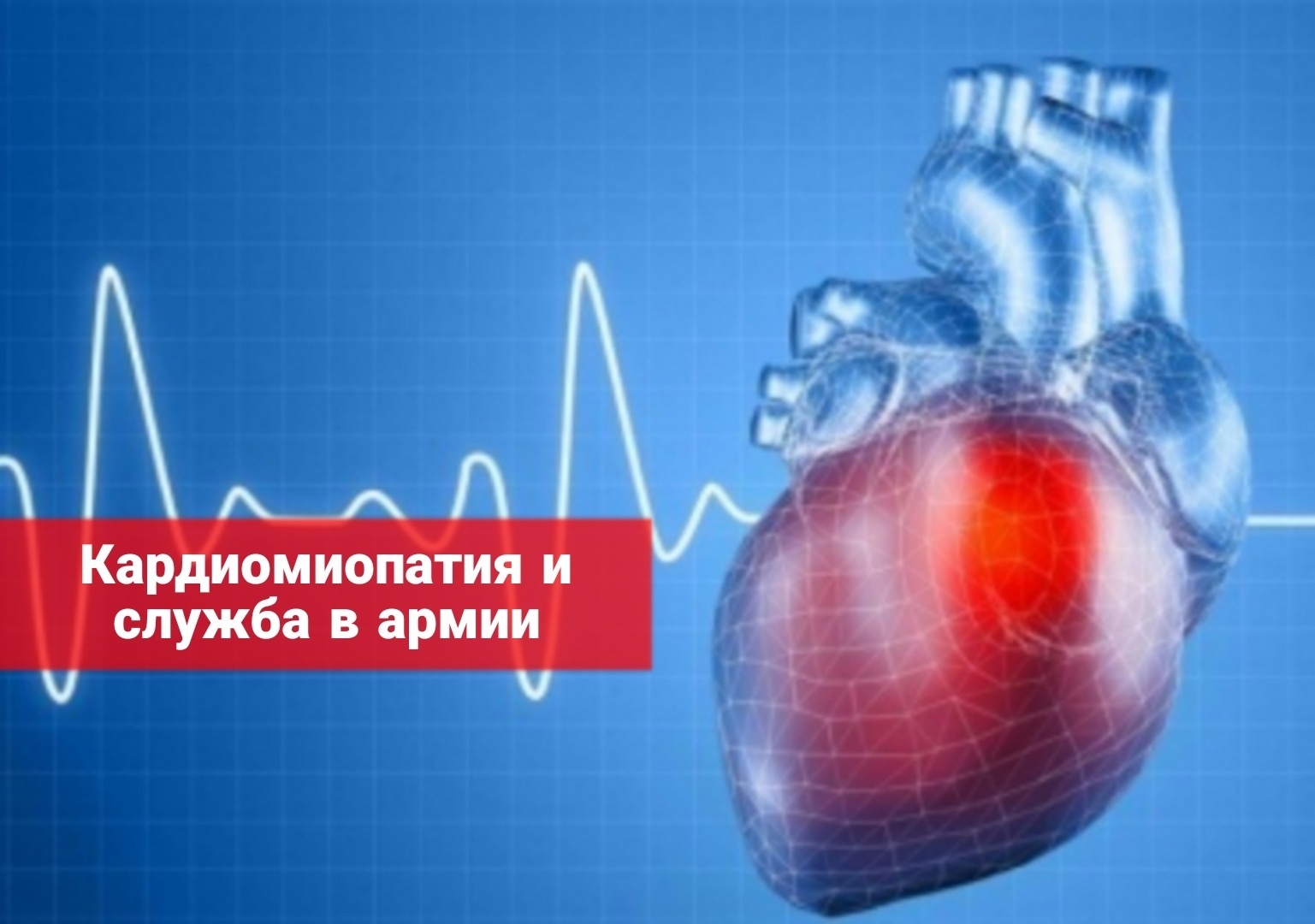 Кардиомиопатия и служба в армии