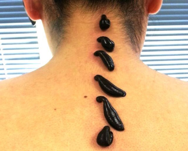 В чем польза гирудотерапии и какие противопоказания к ее выполнению?