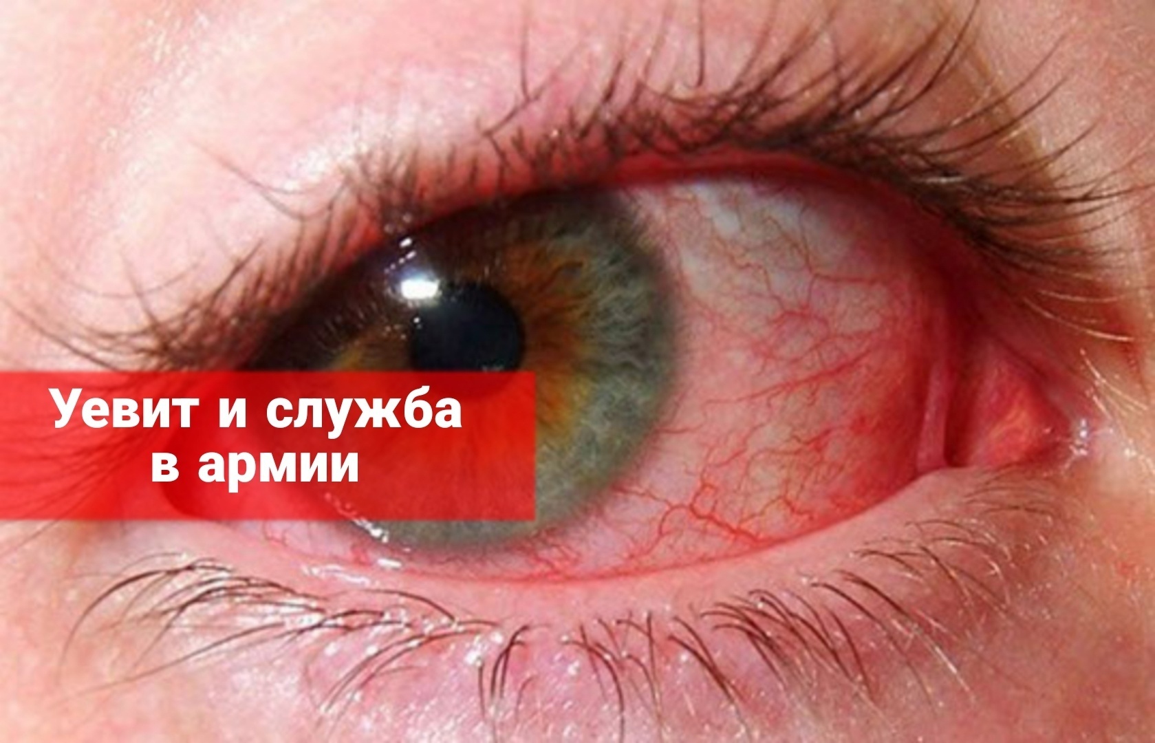 Увеит и служба в армии