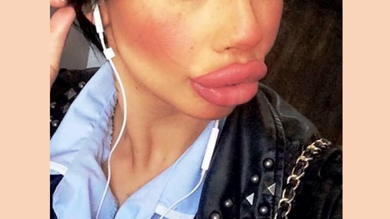 Как не платить за пластику губ большие деньги, или Квест по врачам