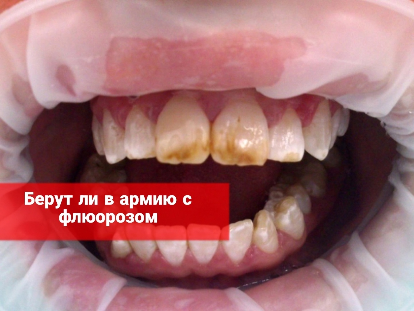 Берут ли в армию с флюорозом