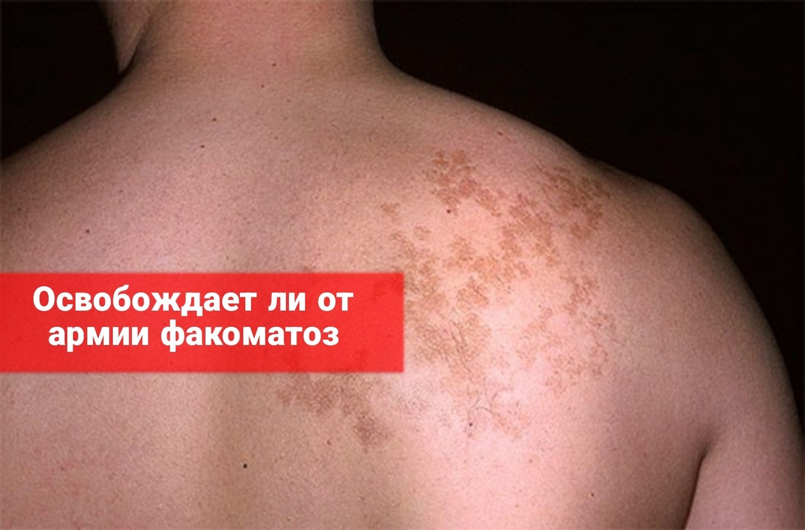 Освобождает ли факоматоз от армии