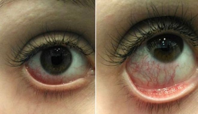 5 побочных эффектов наращивания ресниц.