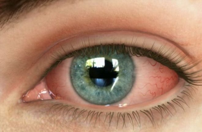 5 побочных эффектов наращивания ресниц.