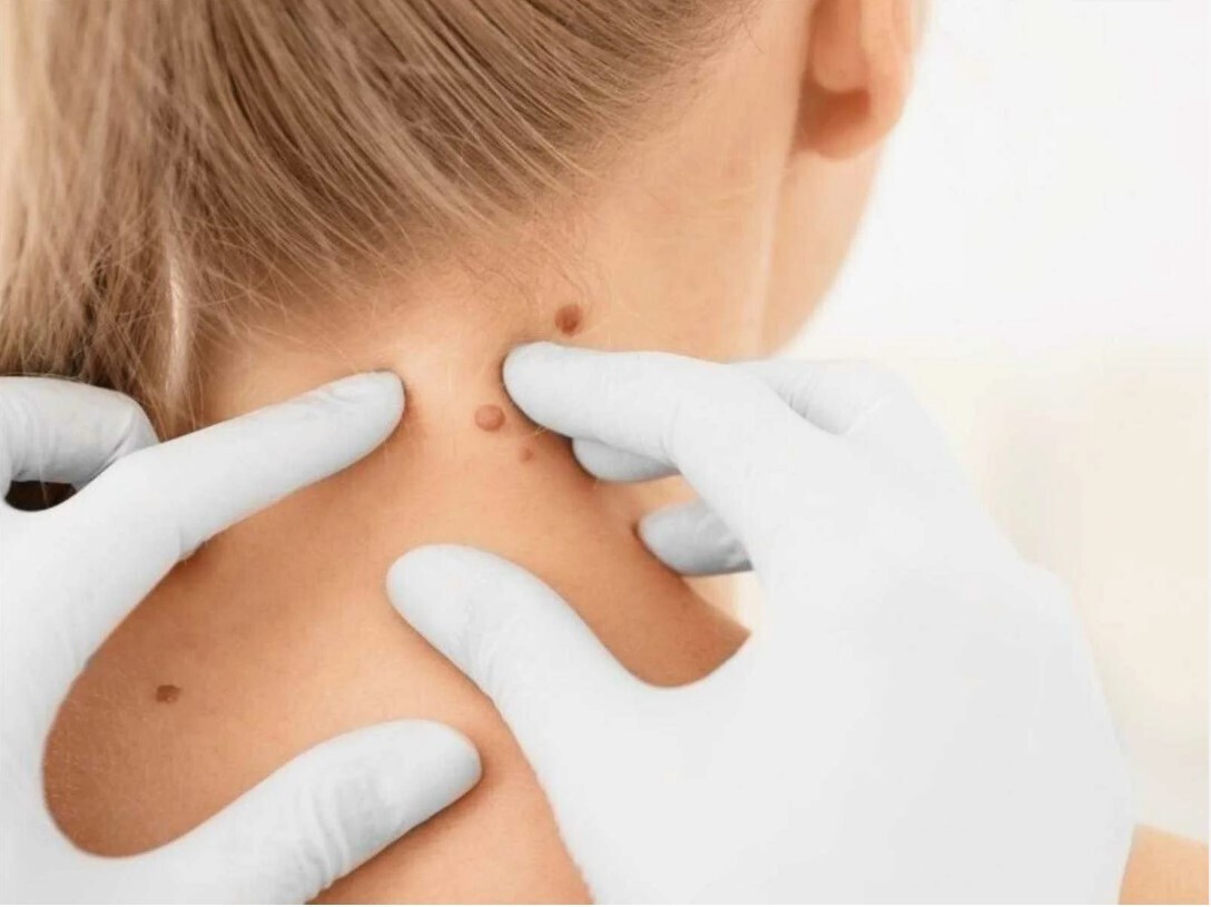 Домашние секреты: Естественное избавление от папиллом для безупречной кожи