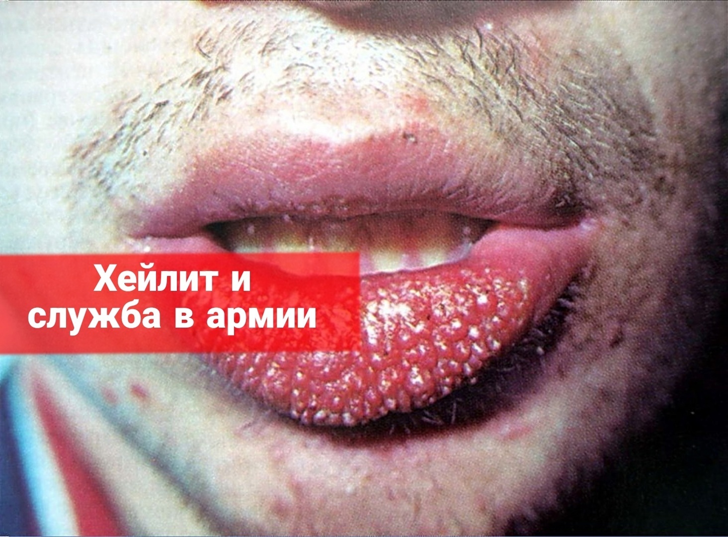 Хейлит и служба в армии