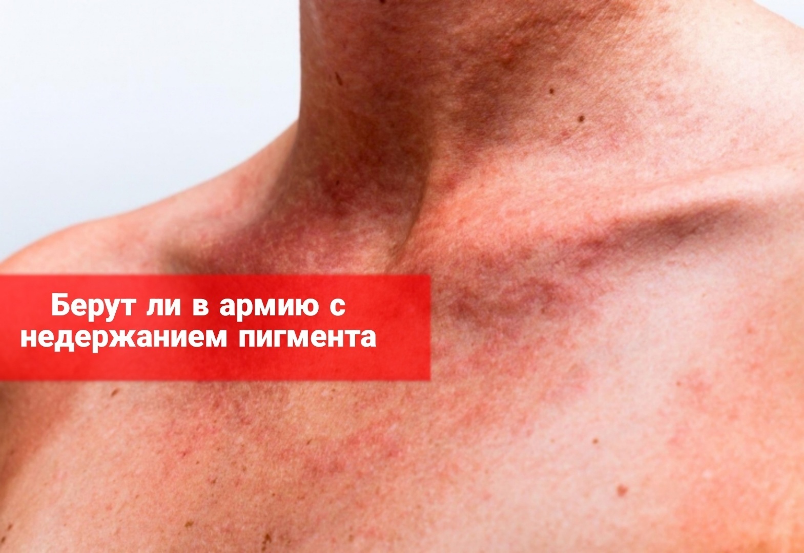 Берут ли в армию с синдромом недержания пигмента