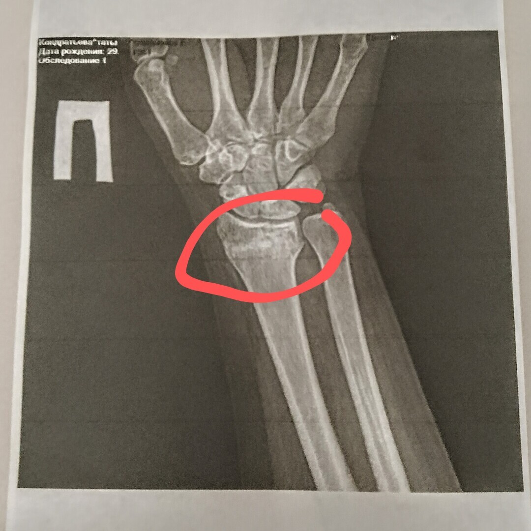 Как не сойти с ума, если ты сломала правую руку и осталась одна с собакой, двумя котами, дачей и жарой под 50…