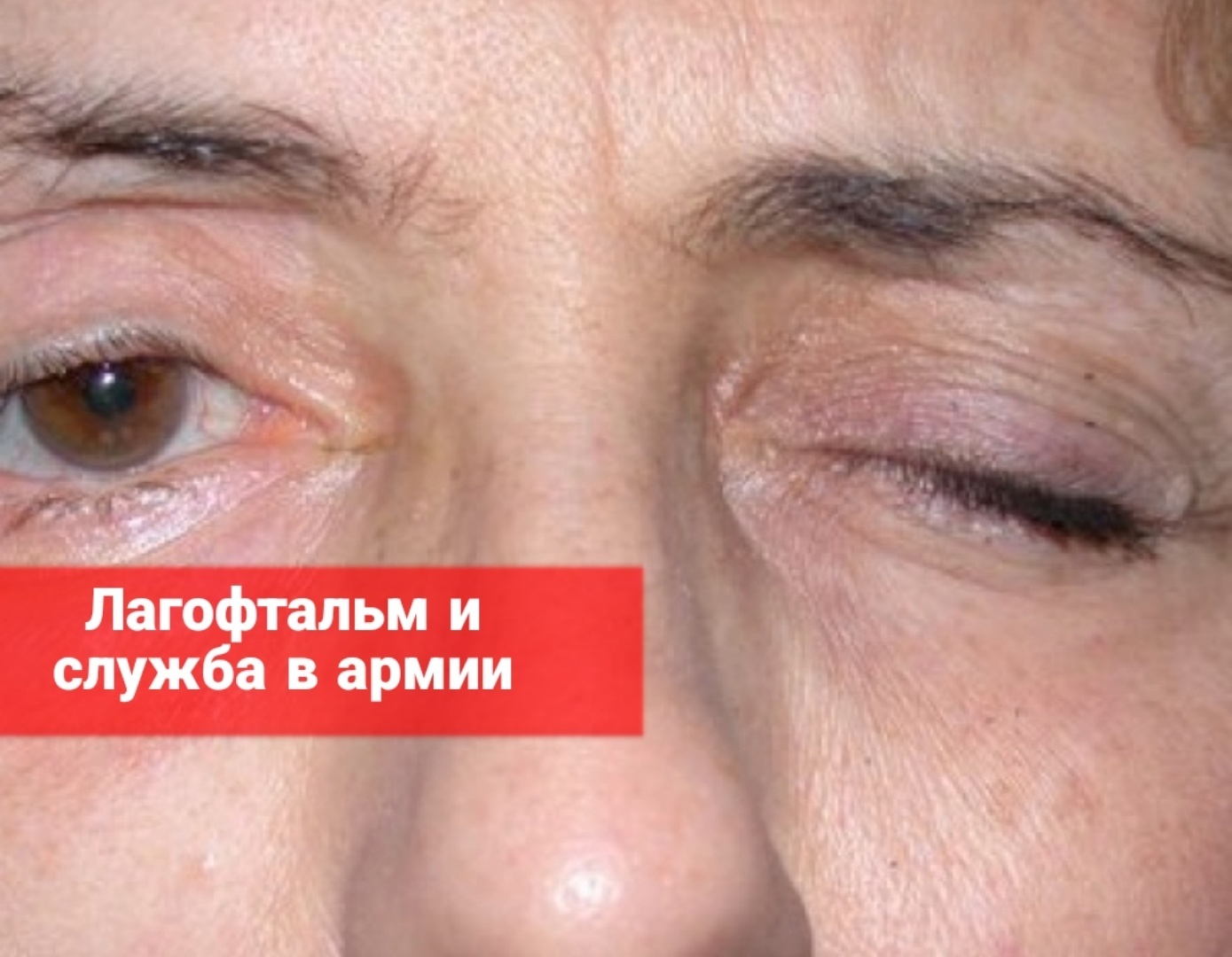 Лагофтальм и служба в армии
