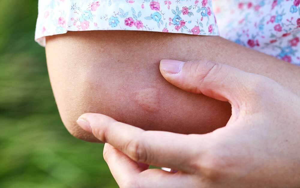 Что происходит в теле после укусов комаров и как помочь организму?