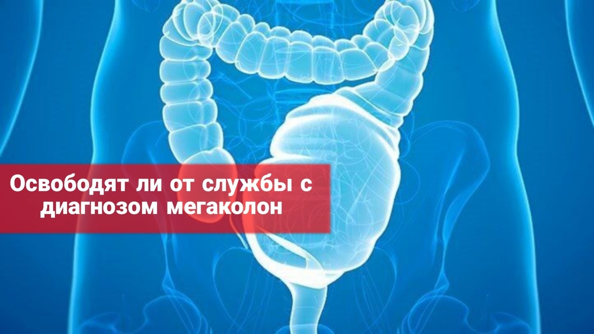 Освободят ли от службы с диагнозом мегаколон