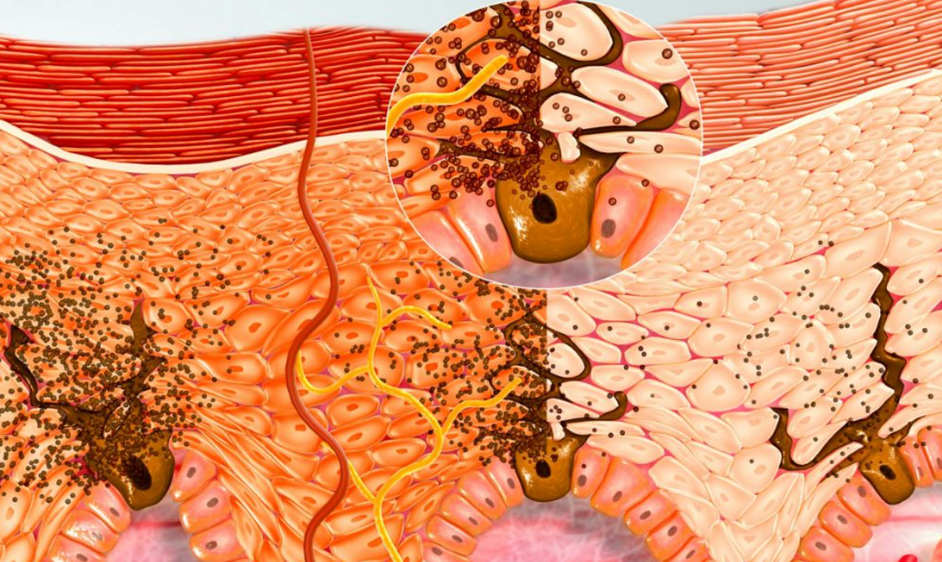 Чем отличается нордический (северный) загар от южно-турецкого?