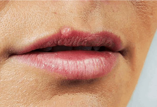 Как быстрее избавиться от высыпаний всеми «любимого» герпеса?