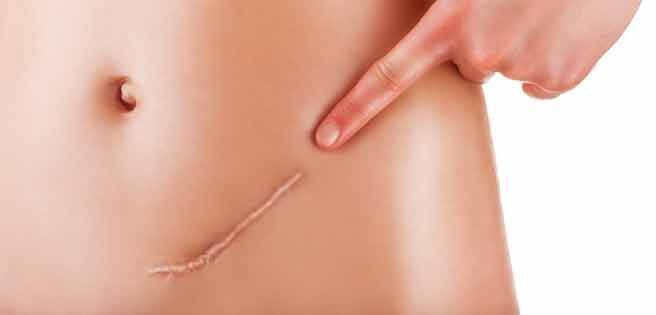 Что такое келоидные рубцы и как от них избавиться?